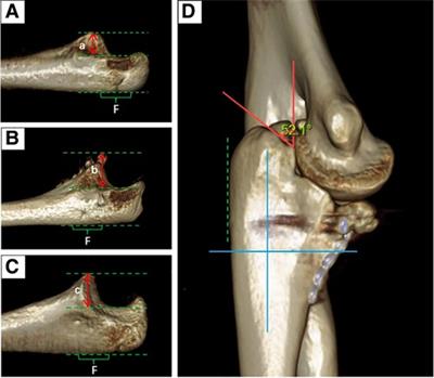 Reconstruction of the coronoid process with the olecranon tip for chronic elbow dislocation in children: A rare case report and literature review